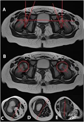 Lower limb maltorsion and acetabular deformity in children and adolescents with X-linked hypophosphatemia